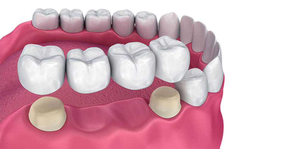 Dental Bridges Carleton Place