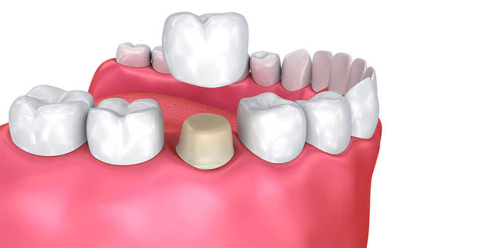Dental Crowns Carleton Place