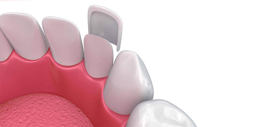 Dental Veneers Carleton Place