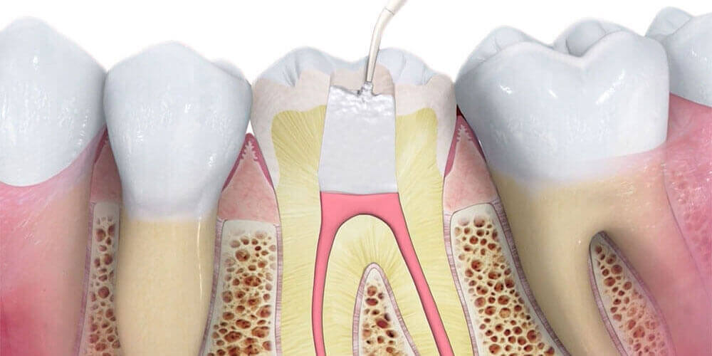 Root Canal Treatment Carleton Place