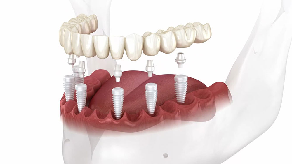 Dental Implants in Carleton Place Dental Implants in Carleton Place