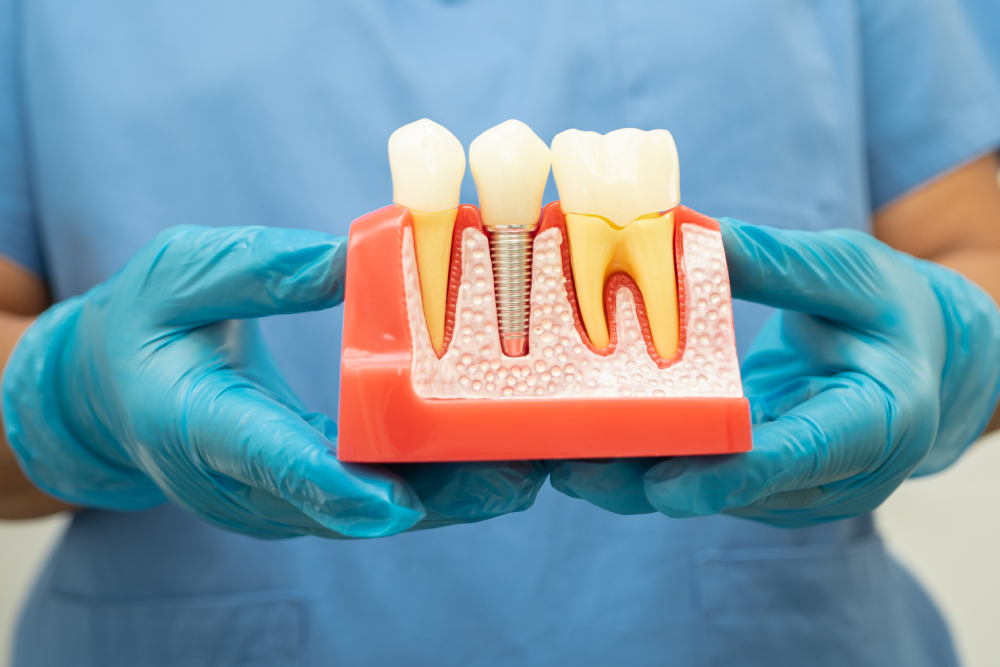 Single Tooth Implants in Carleton Place Single Tooth Implants in Carleton Place